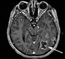 Metastatski tumori mozga