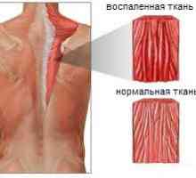 Miozitis mišiće leđa i vrat