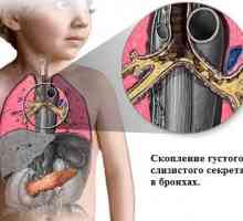 Cistične fibroze (cistična fibroza)