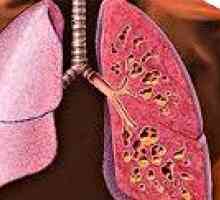 Cistična fibroza pluća