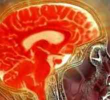 Zamjena na otvorenom mozgu hidrocefalusa