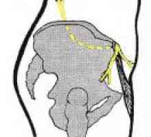 Neuropatija vanjski femoralne kožnog živca