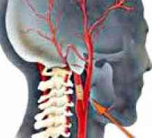 Okluzija karotidne arterije