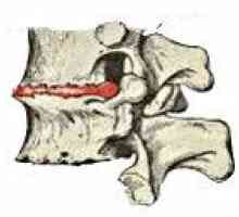 Osteohondroze