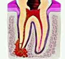 Akutnog parodontitisa
