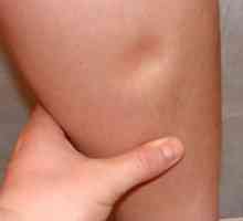 Oticanje nogu tokom trudnoće