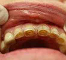 Patološki stomatološke abrazije
