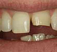 Zub fraktura