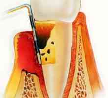 Parodontitisa: Simptomi i tretman