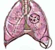 Planocelularni karcinom pluća