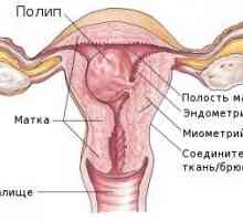 Endometrija polipa. endometrija polip