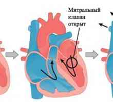 Prolaps mitralne srčanih zalistaka