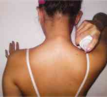Akne na leđima i ramenima