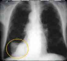 Rak pluća: simptomi, znakovi, liječenje