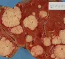 Rak jetre: Simptomi i dijagnoza