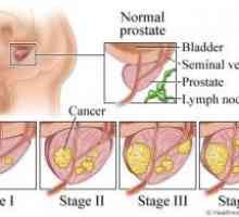 Rak prostate
