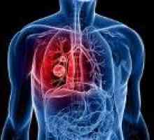 Rak pluća relapsa
