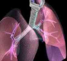 Respiratorni distres sindrom