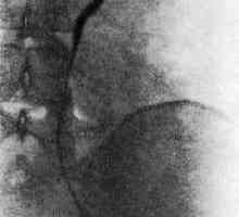 Retroperitonealni fibroze (Ormond bolest)