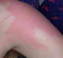 Sunburn (photodermatitis)