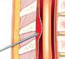Spinal epiduralna krvarenja