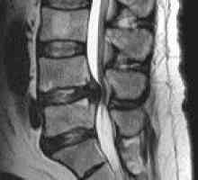 Spinal epiduralne apsces