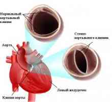 Stečena stenoza aorte (aortna stenoza)