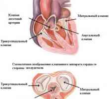 Stenoza mitralne valvule (mitralna stenoza)