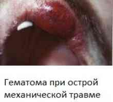 Stomatitis (upala usne šupljine) sa fotografijama