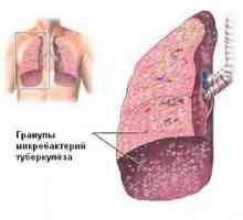 Plućne tuberkuloze