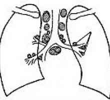Tuberkuloza intratorakalnih limfnih čvorova