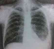 Tuberkulozni pleuritis