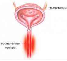 Uretritis kod žena
