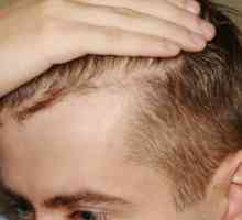 Gubitak kose kod muškaraca: uzroci, liječenje, sredstva