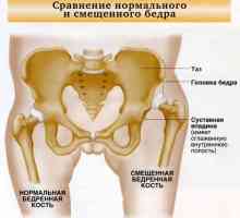 Hip dislokacija. Simptomi i tretman urođenih dislokacije kuka kod djece