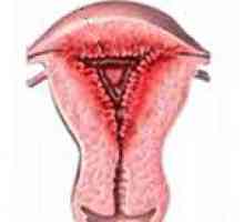 Žlezdane endometrija hiperplazija