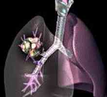 Malignih tumora pluća