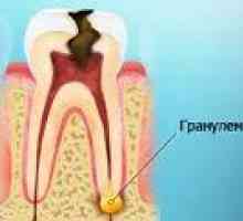 Zub granulom