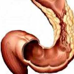 Debelog crijeva adenokarcinom