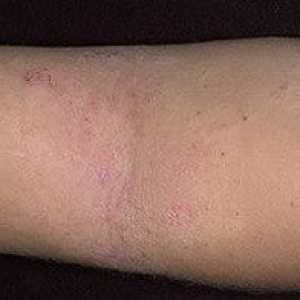 Atopijskog dermatitisa