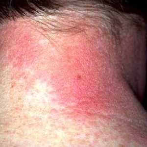 Alergijski dermatitis: Simptomi i tretman