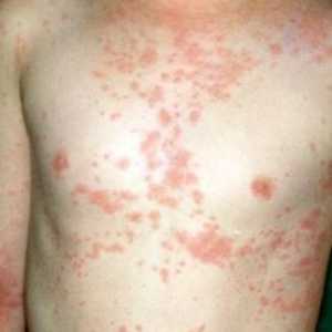 Atopijski dermatitis: Simptomi i tretman
