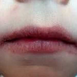 Alergijske inflamacija usana