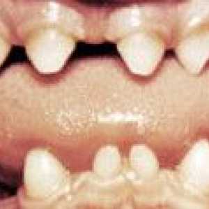 Abnormalnosti oblik zuba