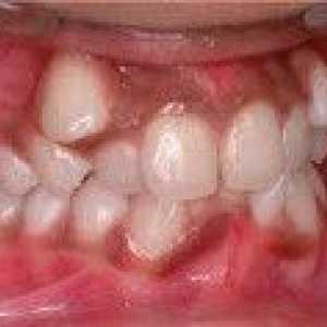 Anomalije denticije