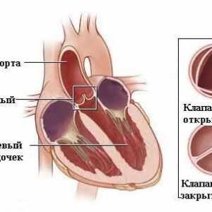 Aorte insuficijencijom (aortne valvule)