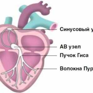 Srčanih aritmija