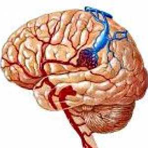 Arteriovenske malformacije mozga