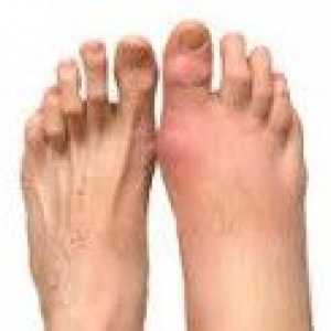 Artritisa stopala