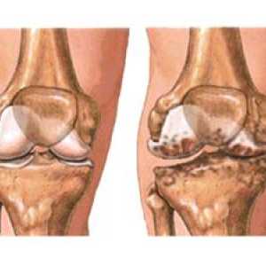 Osteoartritisa koljena (gonartroza)
